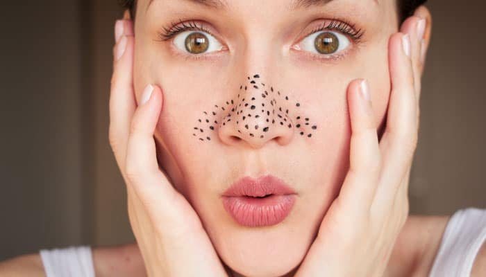 Get Rid Of Blackheads On Nose Fast