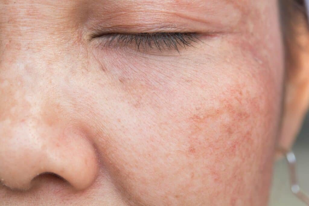 How To Get Rid of Age Spots