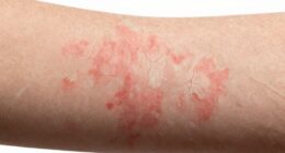 dry skin with dermatitis