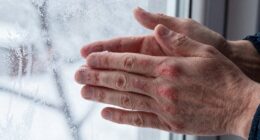 cold weather dries skin